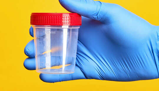 Urine test detects new or returning bladder cancer A blue-gloved hand holds a urine test cup with a red lid
